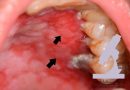What is Mucous Membrane Pemphigoid & It’s Ayurvedic Treatment with Herbal Remedies