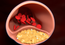 Triglycerides and Cholesterol