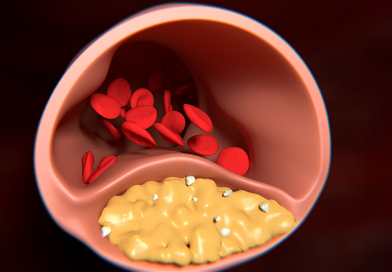 Triglycerides and Cholesterol