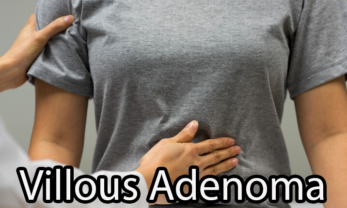 Villous Adenoma