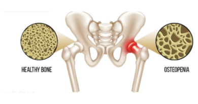 Natural Ayurvedic Treatment for Osteopenia – Causes, Symptoms & Herbal Remedies Natural Ayurvedic Treatment for Osteopenia – Causes, Symptoms & Herbal Remedies