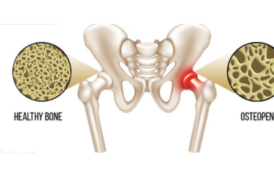 Natural Ayurvedic Treatment for Osteopenia – Causes, Symptoms & Herbal Remedies