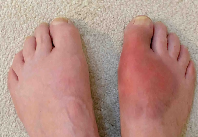 Gout