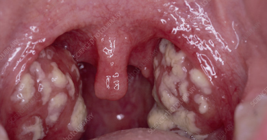 Tonsils Treatment Through Ayurveda – Natural & Effective Remedies Tonsils
