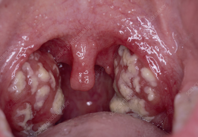 Tonsils