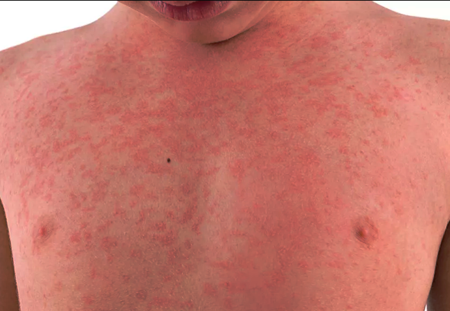 Immune Thrombocytopenic Purpura (ITP)
