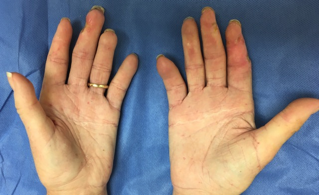 scleroderma