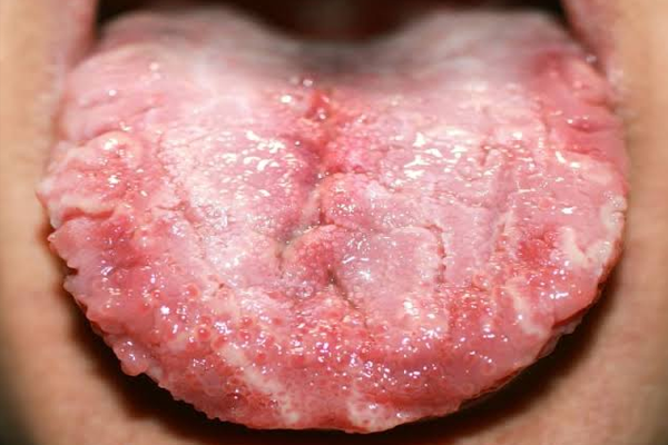 Candidiasis