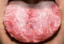 Candidiasis