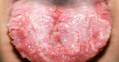 Candidiasis
