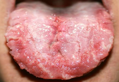 Candidiasis