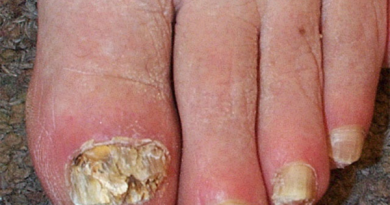 Ayurvedic Treatment and Care for Onychomycosis (Fungal Nail Infection) Fungal Nail Infection