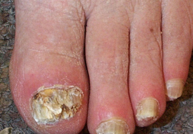 Ayurvedic Treatment and Care for Onychomycosis (Fungal Nail Infection) Fungal Nail Infection