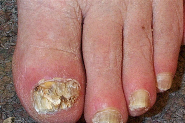 Fungal Nail Infection Fungal Nail Infection