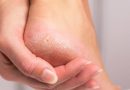 Hyperkeratosis