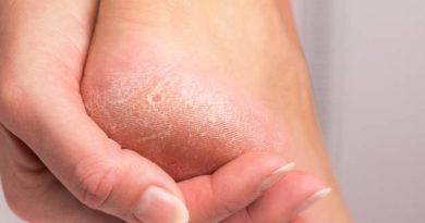 Hyperkeratosis – Causes, Symptoms, Treatment & Herbal Remedies for Healthy Skin Hyperkeratosis