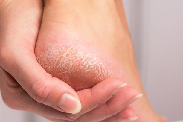 Hyperkeratosis