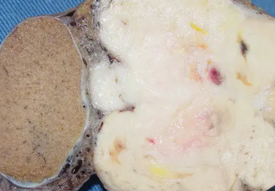 Alternative Medicines for Paratesticular Pleomorphic Leiomyosarcoma Paratesticular pleomorphic leiomyosarcoma