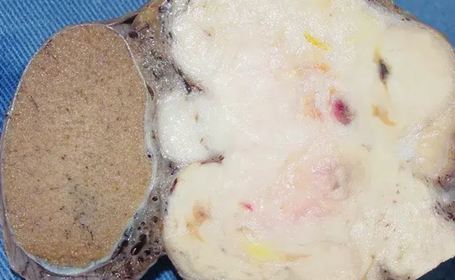 Paratesticular pleomorphic leiomyosarcoma Paratesticular pleomorphic leiomyosarcoma