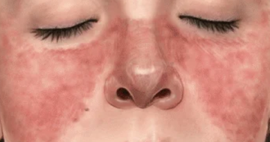 Systemic Lupus Erythematosus