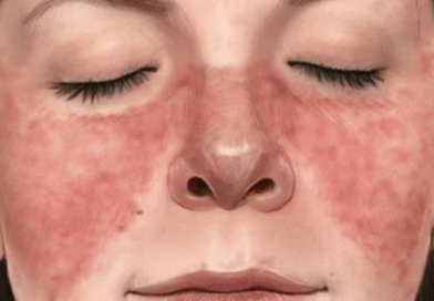 Systemic Lupus Erythematosus