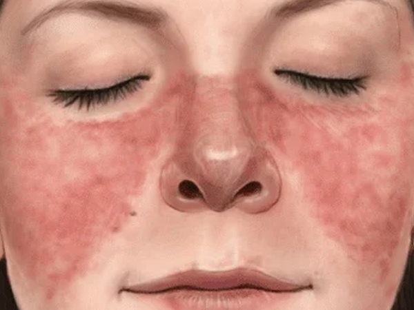 Systemic Lupus Erythematosus Systemic Lupus Erythematosus