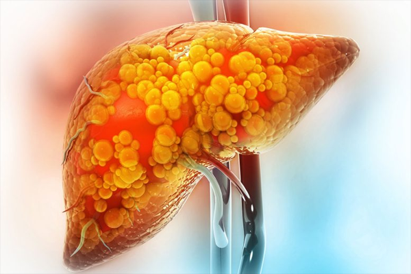 fatty liver fatty liver