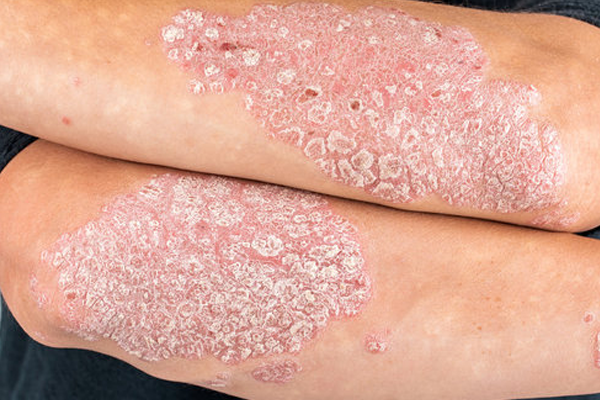 psoriasis