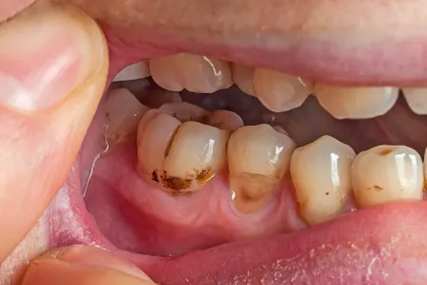 Dental plaque Dental plaque