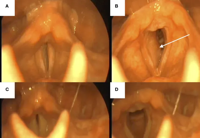 Subglottic cancer Subglottic cancer