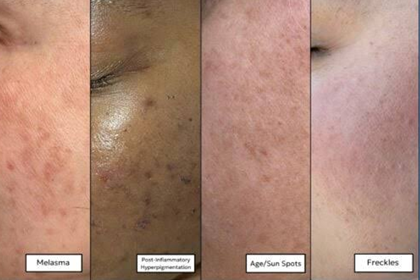 Types of discoloration Types of discoloration