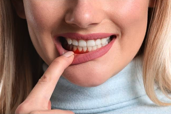 gingivitis gingivitis