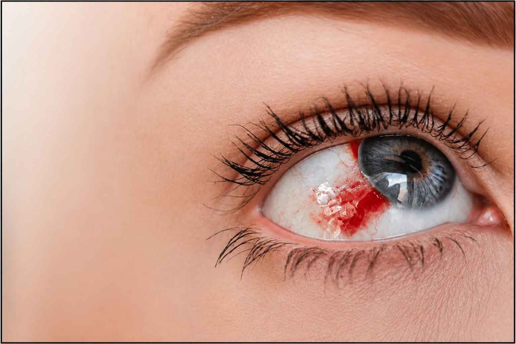 Hemorrhagic Disorders Hemorrhagic Disorders