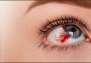 Arakeshwar Ras – Ayurvedic Benefits, Uses & Key Ingredients Hemorrhagic-Disorders