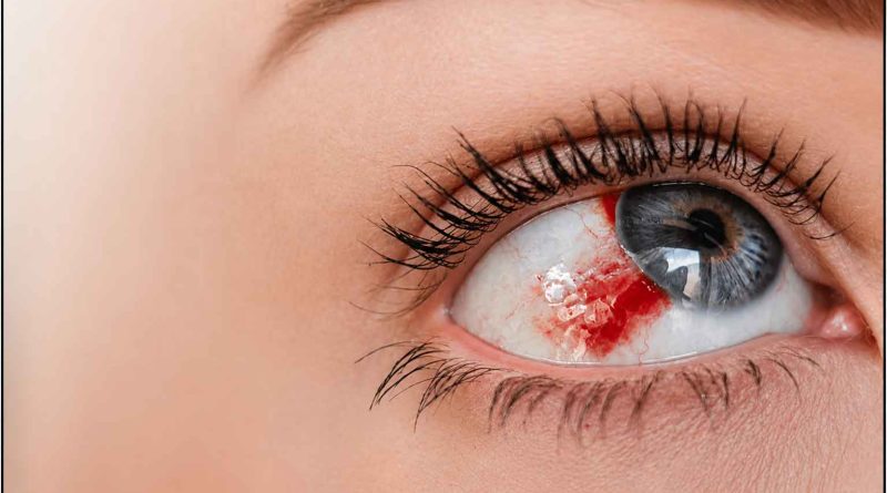 Hemorrhagic-Disorders