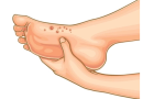 Herpes-on-Feet