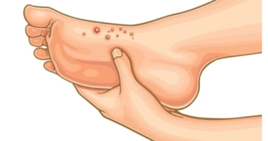 Herpes-on-Feet
