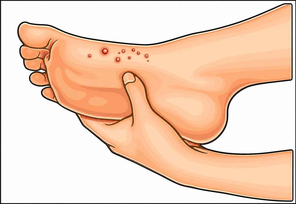 Herpetic Whitlow Herpetic Whitlow