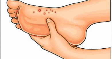 Herpes on Foot (Herpetic Whitlow) – Causes, Symptoms, Treatment & Herbal Remedies Herpetic Whitlow