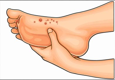 Herpes on Foot (Herpetic Whitlow) – Causes, Symptoms, Treatment & Herbal Remedies Herpetic Whitlow