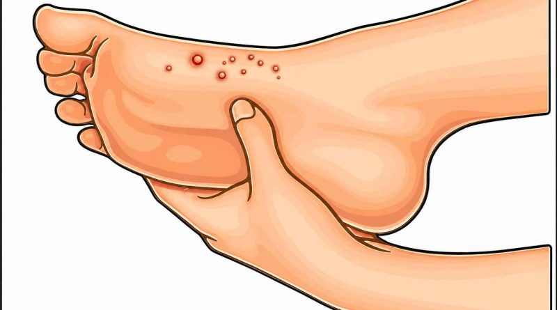 Herpes on Foot (Herpetic Whitlow) – Causes, Symptoms, Treatment & Herbal Remedies Herpetic Whitlow