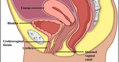 Urethrovaginal Fistula – Ayurvedic Management & Treatment Urethrovaginal Fistula