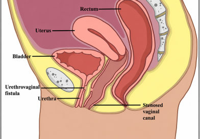 Urethrovaginal Fistula – Ayurvedic Management & Treatment Urethrovaginal Fistula