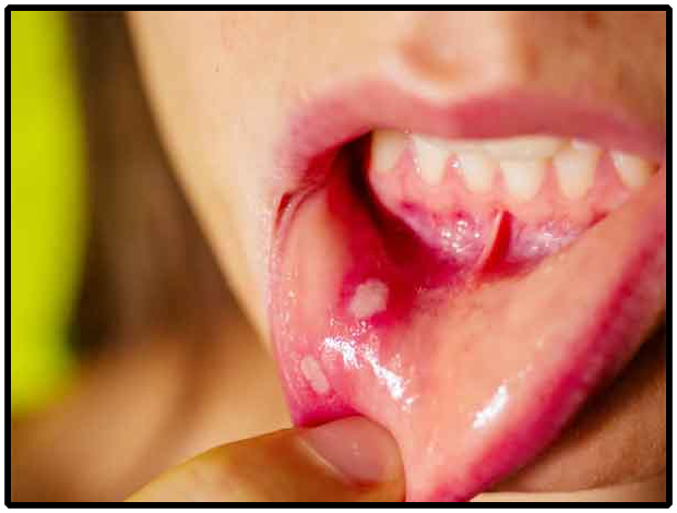 Mouth Ulcer Mouth Ulcer