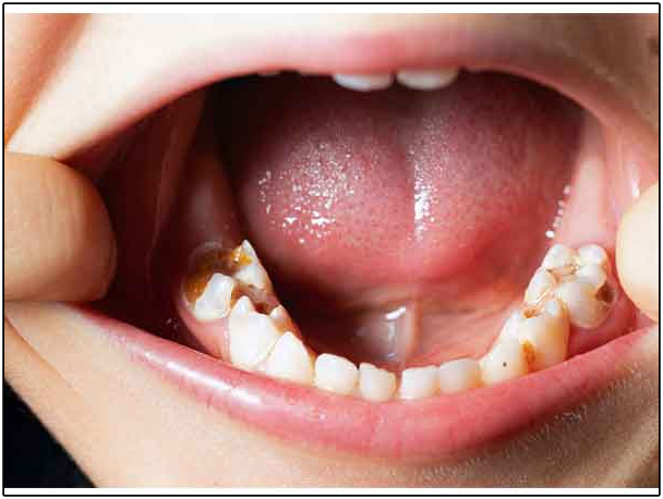 Caries