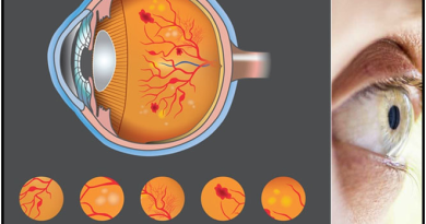 Diabetic Retinopathy