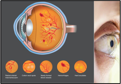 Diabetic Retinopathy