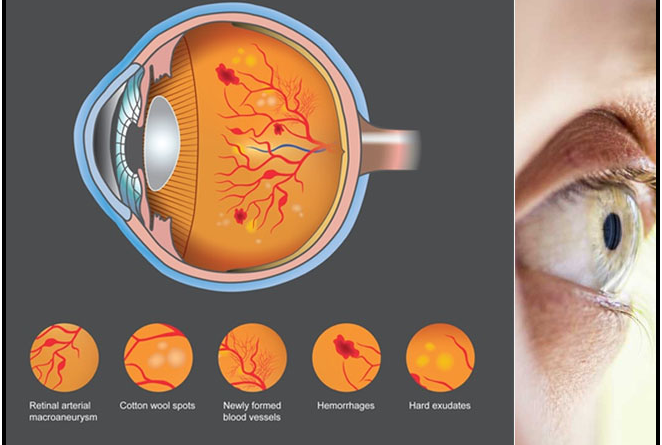 Diabetic Retinopathy