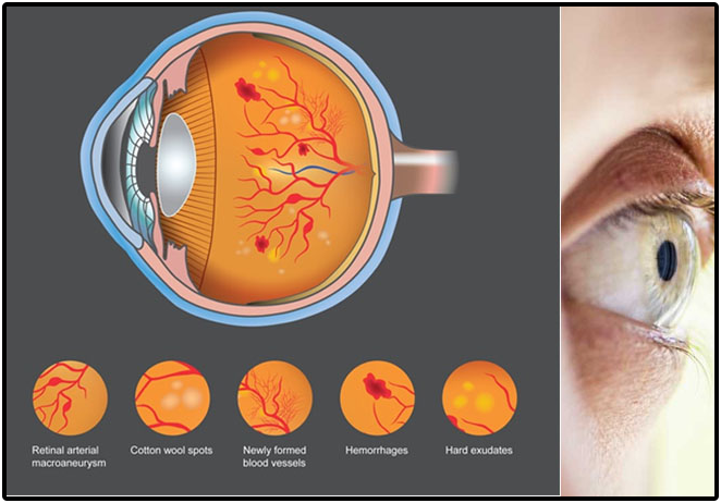 Diabetic Retinopathy