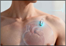 Implantable Loop Recorder (ILR)-Uses, Benefits & Ayurveda for Heart Rhythm Implantable Loop Recorder